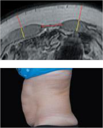 EMsculpt Fat Reduction Therapy