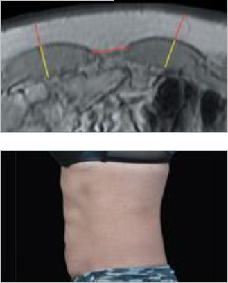 EMsculpt Fat Reduction Therapy