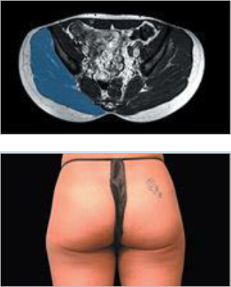 EMsculpt Fat Reduction Therapy