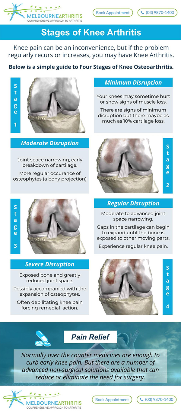 Four Stages of Knee Arthritis