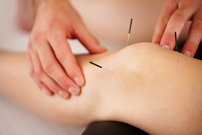 Acupunctue