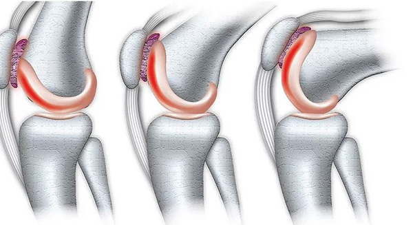 Chondromalacia Patella