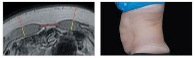 EMsculpt Fat Reduction Therapy Image