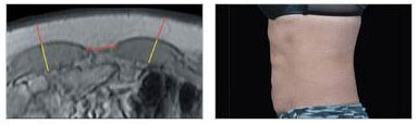 EMsculpt Fat Reduction Therapy Image