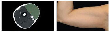 EMsculpt Fat Reduction Therapy Image