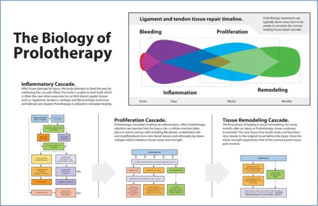 prolotherapy